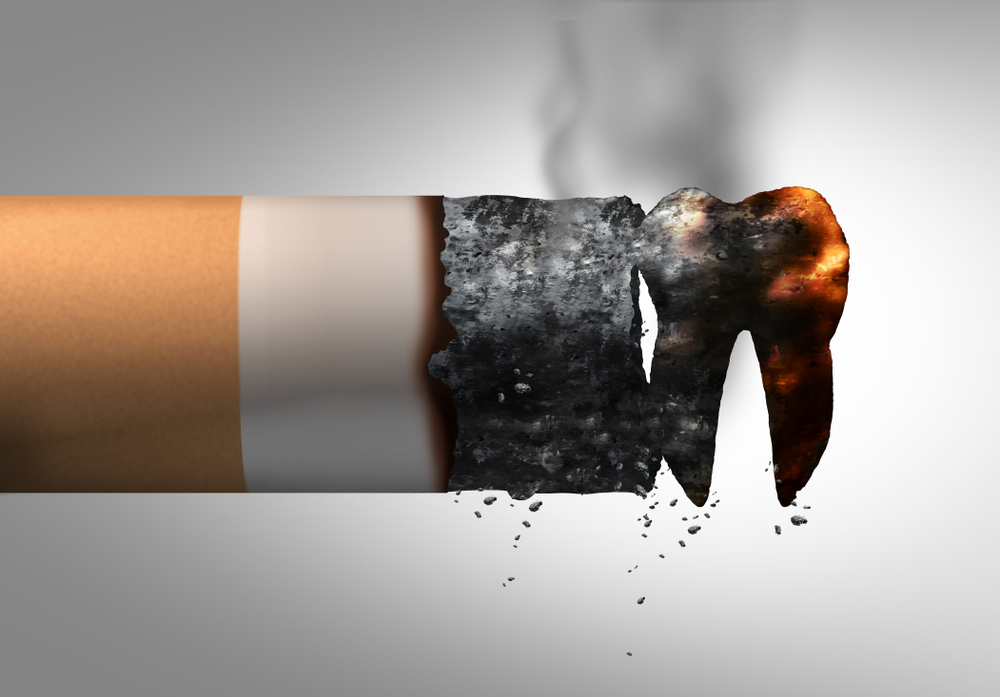 インプラント治療が終了しても禁煙すべき？