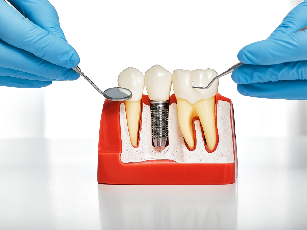 インプラントの歯周病を放置するとどうなる？
