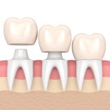 インプラント治療で人工歯根と人工歯を接着させる方法「セメントタイプ」とは？