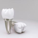 インプラントの人口歯とアバットメントに使用される素材を紹介