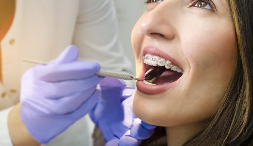 インプラント治療後に歯の矯正は可能！ただし難しいケースもあります