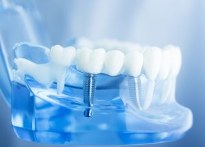 奥歯2本をインプラントにする場合の費用相場を解説！同時治療で安くなる？