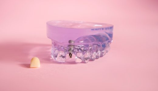 前歯をインプラント治療する場合の費用相場を解説！１本いくら？