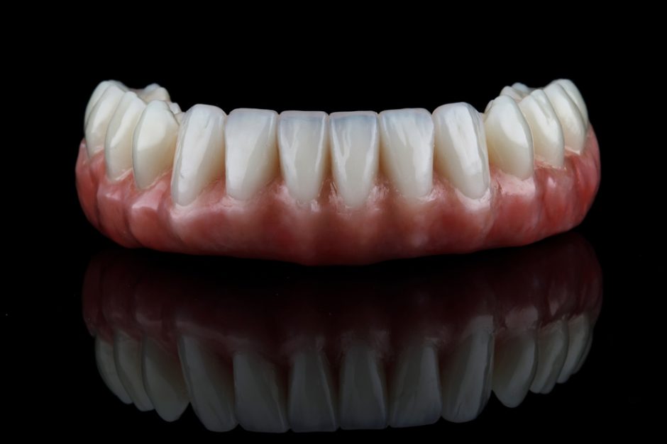 インプラント治療後に歯茎が黒くなる原因と予防方法を解説