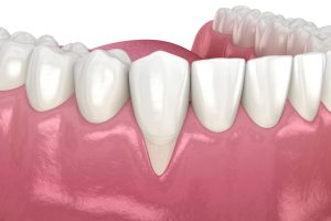 インプラント治療後に歯茎が下がる原因とおすすめの予防方法を解説