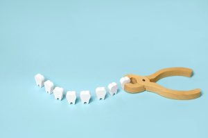 抜歯の最大の原因は歯周病！重度になった場合の選択肢は？