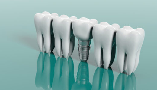 インプラントの人工歯「メタルボンド」とは？メリット・デメリットを紹介