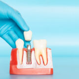 インプラントの人工歯根に使われるチタンの種類を解説