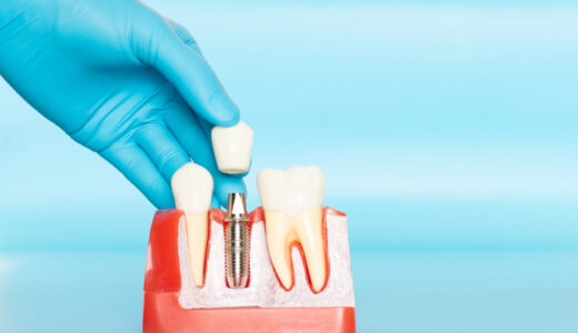 インプラントの人工歯根に使われるチタンの種類を解説